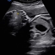 뽀덕이 기록 - 임신 37주, 출산 안내사항