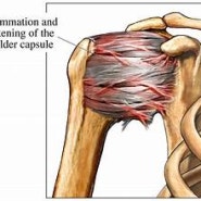 극심한 어깨의 통증, 오십견 치료 어떻게 해야할까요?