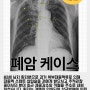 목에서 피가래 객혈원인 김포조현철내과 폐암 케이스 보고