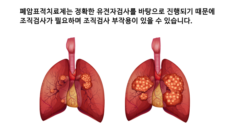 비소세포 폐암 표적항암치료제 장단점과 내성 : 네이버 블로그
