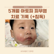 D+178~179 5개월 아기 아토피 신생아 피부염 경과기록