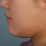 [유캔비성형외과] 실리프팅,턱밑지방흡입 2개월 경과
