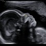임신 20주 : 태아 정밀초음파 후기! 20주 정밀초음파에서 확인할 수 있는 것들