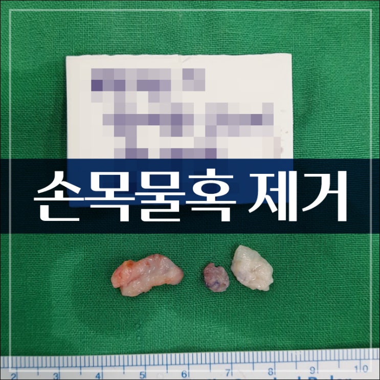 손목 물혹 결절종, 신경절 낭종 원인 및 증상 치료는 어떻게? : 네이버 블로그