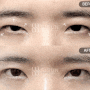 남자무쌍눈매교정으로 졸린 눈, 짝눈 개선하기(+풀트임)