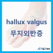 강서구정형외과 엄지발가락 통증원인 무지외반증 치료와 예방은 서울원병원