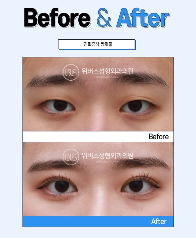 쌍꺼풀 수술 후 라인이 낮아지는 이유 : 네이버 블로그