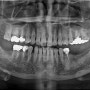 임플란트 치료기간, 왜 치과마다 다른가요?