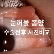 눈꺼풀 종양 안검종양 수술ㅣ수술 전후 사진 비교