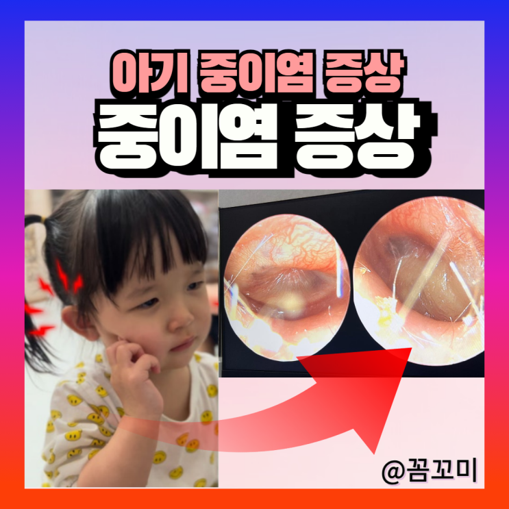 아기 중이염증상 원인 열 전염 항생제 약 중이염치료 : 네이버 블로그