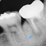 다른 치과 임플란트 수술 예약해놨는데 다른 방법이 있는지 궁금해요 잠실치과 잠실임플란트