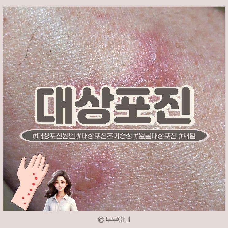 대상포진 눈 얼굴 흉터 대상포진 초기 증상 원인 치료 재발 전염성 대상포진후신경통 : 네이버 블로그