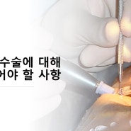 백내장 수술에 대해 알아두어야 할 사항