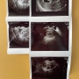 임신 5-6W #1 갈색혈, 난황, 아기 확인