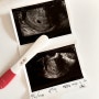 [임신 4주] 4주 6일 드디어 첫, 초음파 아기집 확인 👶🏻