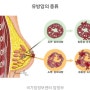 대한민국 여성암 1위, 유방암