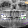 죽전동 치과 오랜기간 방치되어 있는 치아는 임플란트를 필요로 하게 될 수 있습니다. (정기검진의 중요성)