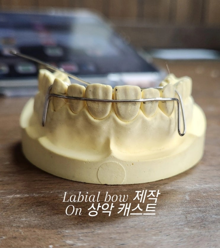 [🦷교정실습] labial bow 제작, wire bending : 네이버 블로그