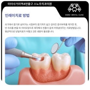 노원 충치치료 비용, 충치 단계별 치료방법 알려드려요