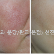 악성 안면홍조증(Facial flushing), 주사 피부염(Rosecae, 장미진) 치료사례, 브이빔이 오히려 악화시킬 수 있는 케이스