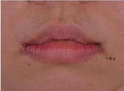 연예인 입꼬리 올리기 성형 수술 가격, 부작용 총정리.. : 네이버 블로그
