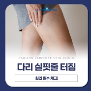 다리 실핏줄 터짐 원인 확인은 필수