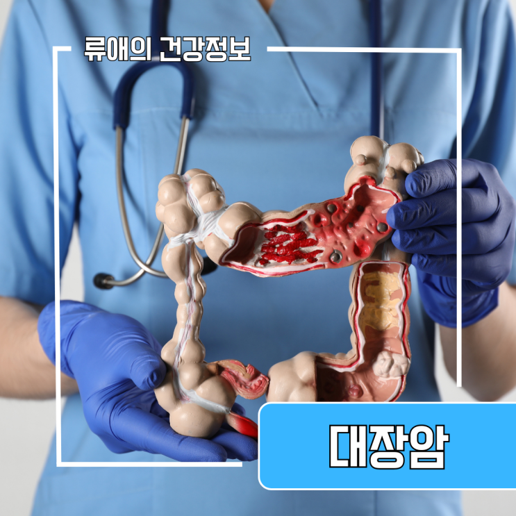 초기대장암증상 및 대장암말기증상 대장암 1기 4기 증세 생존율 : 네이버 블로그