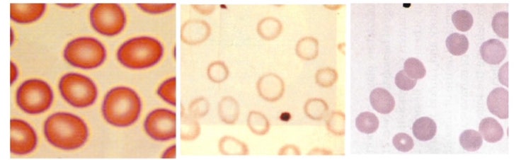 [Hematology]Chapter8_Abnormal RBC and inclusion bodies_비정상 크기의 적혈구와 비정상 ...