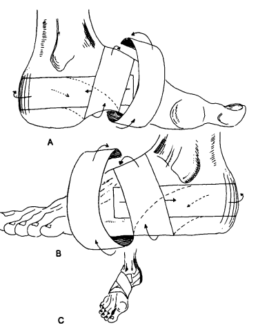발바깥쪽이 아파요, 입방골증후군(Cuboid syndrome) 원인 증상 치료 : 네이버 블로그
