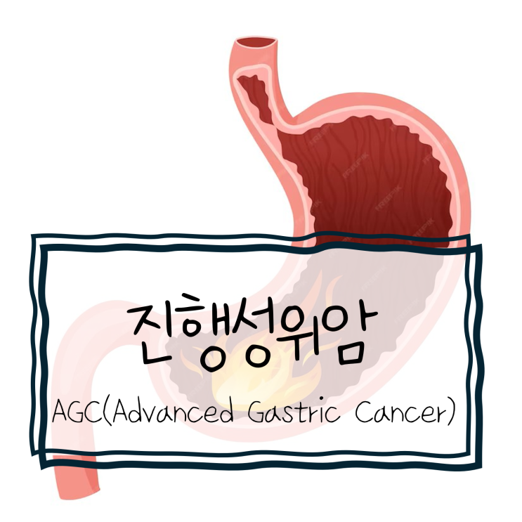 [OR] 진행성위암(AGC, Advanced Gastric Cancer) : 네이버 블로그
