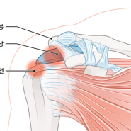 부산 서면 어깨 통증, 어깨 충돌 증후군 원인 및 증상 치료 방법