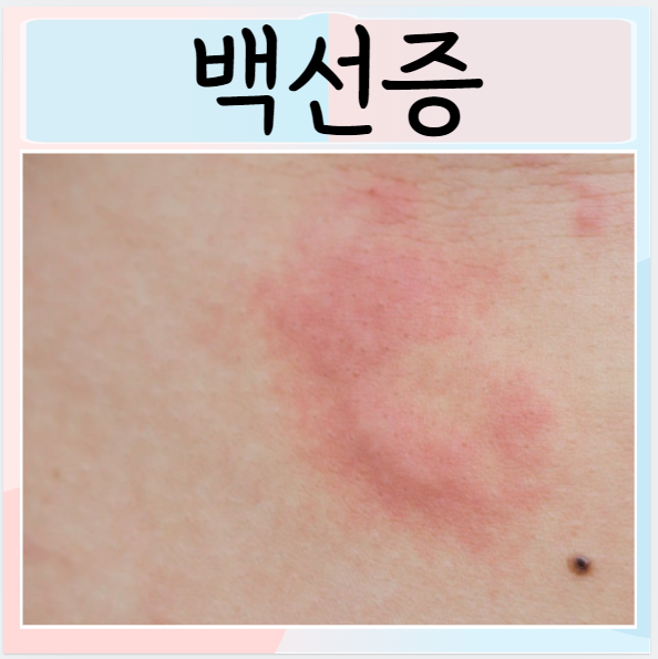 백선증 원인 증상 비슷한 질환들 치료 예방법 : 네이버 블로그
