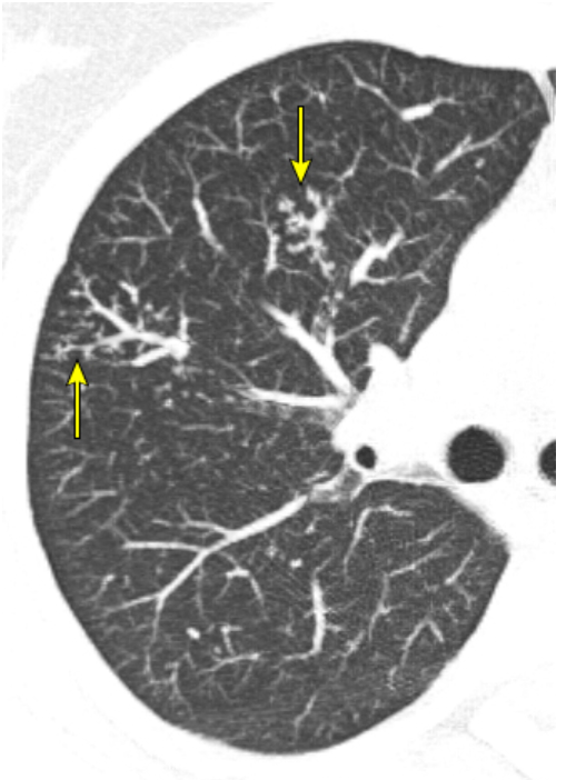 [폐결핵] 폐결핵의 영상 소견, 흉부 X선(XRAY) 및 CT 영상 소견 정리 : 네이버 블로그