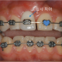 교정치료를 위한 매복치 노출수술