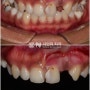 "앞니가 하나 없고, 충치가 많아요" 중앙동 치과 잘하는곳 에서 브릿지로 치료한 증례