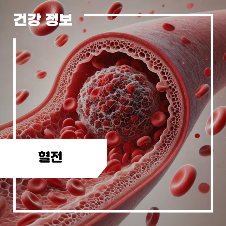 혈전 초기 증상 및 원인, 제거 치료 : 혈전 증상 멍 : 네이버 블로그