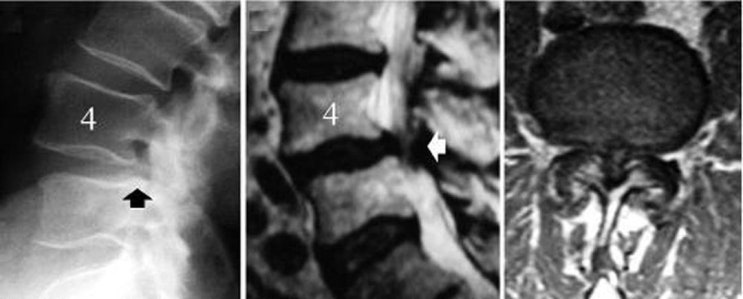 요추 척추관 협착증(Lumbar Spinal Stenosis) : 네이버 블로그