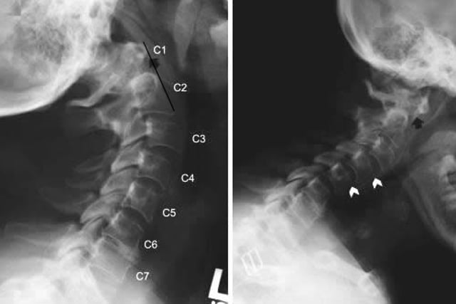대서양축축아탈구(Atlantoaxial Subluxation)(C1–C2 아탈구) : 네이버 블로그
