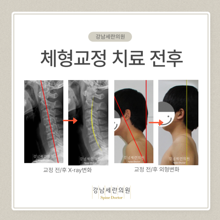 일자목과 거북목 원인과 증상, 경추 교정 치료방법 : 네이버 블로그