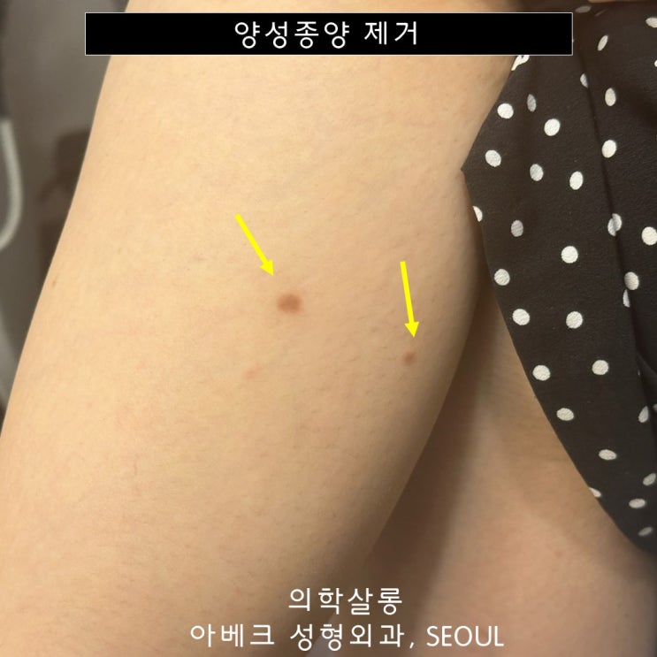 딱딱한 혹, '피부섬유종' 수술 / 보험 / 흉터 【Dr. 아베크 양성종양】 : 네이버 블로그
