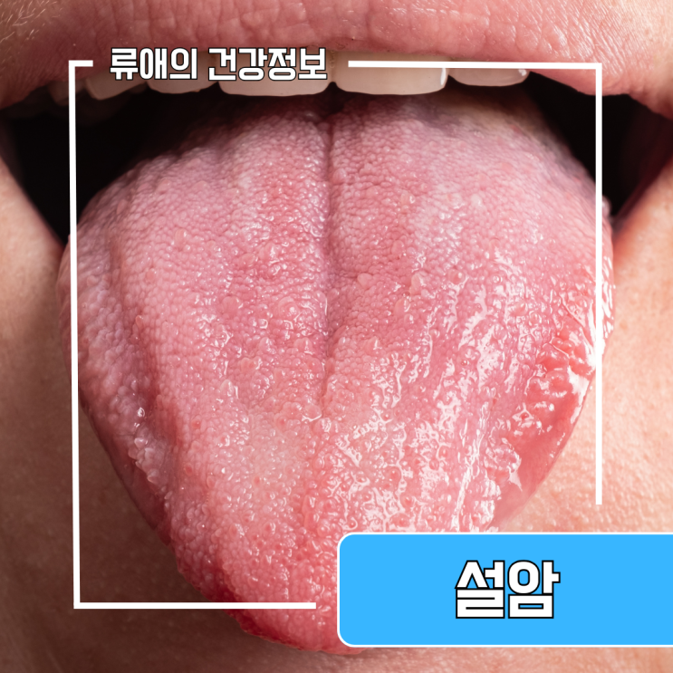 설암초기증상 사진 원인 치료 : 설암 수술 병원 : 네이버 블로그