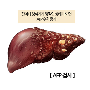 간암 검진 : 네이버 블로그