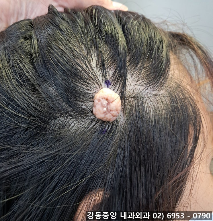 진피내모반 피부섬유종 수술 경북 경주에서 왔어요 (천보성 외과) : 네이버 블로그