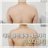 대전 승모근관리 잘하는 "미모다뷰티 원신흥점" 바디슬림톡스 후기