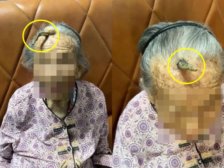 피부과의사가 진단해본 中 107세 할머니 이마 '뿔'의 정체 [피각, 할머니 이마 뿔] : 네이버 블로그