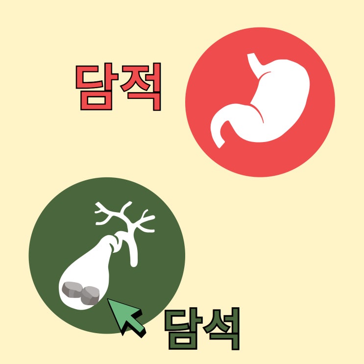 담석(膽石, 쓸개돌)은 담적(痰積)은 발음이 비슷하지만 전혀 다른 병이에요 : 네이버 블로그