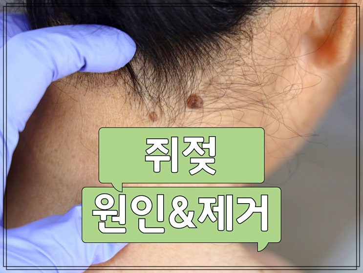 사타구니 쥐젖 원인과 제거 비용 정리 : 네이버 블로그