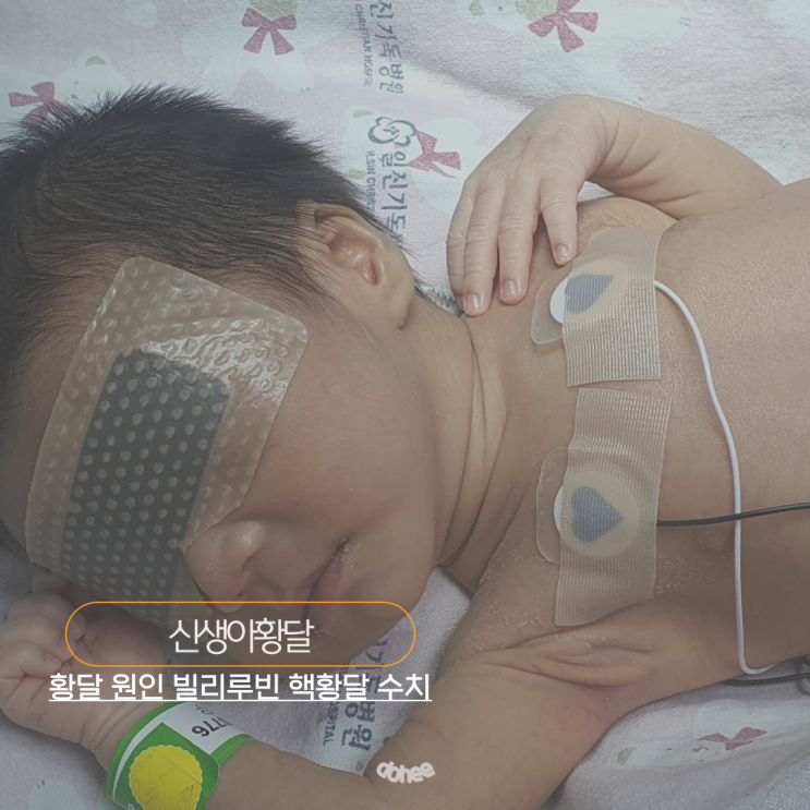 신생아 황달 원인과 증상 빌리루빈 핵황달 수치 : 네이버 블로그