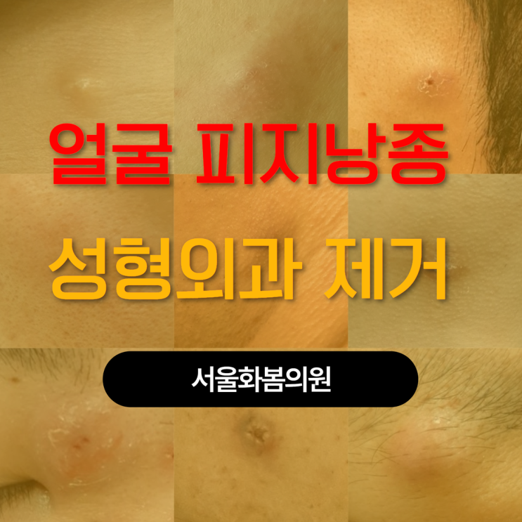 용인 수지 성형외과 얼굴 표피낭종 피지낭종 제거 미세봉합 수술 : 네이버 블로그
