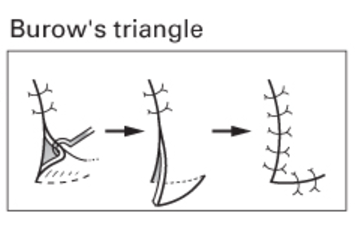 Burrow's triangle 이란 무엇이고, 상안검 수술에 어떻게 이용될까요? : 네이버 블로그